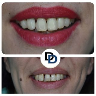 kompozitni faseti dentalna klinika danailovdent 2