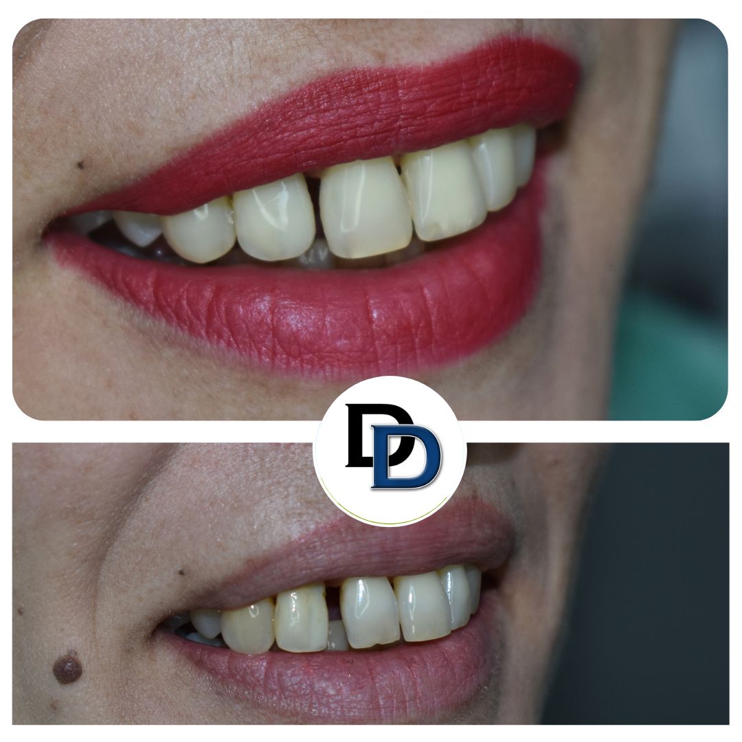 kompozitni-faseti-dentalna-klinika-danailovdent-4.jpg