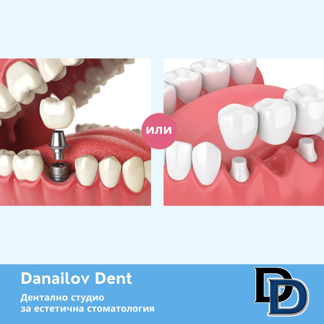 implant-ili-most-danailovdent.jpg