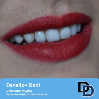 фасети дентална клиника danailovdent 1