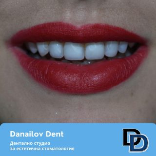 фасети дентална клиника danailovdent 2