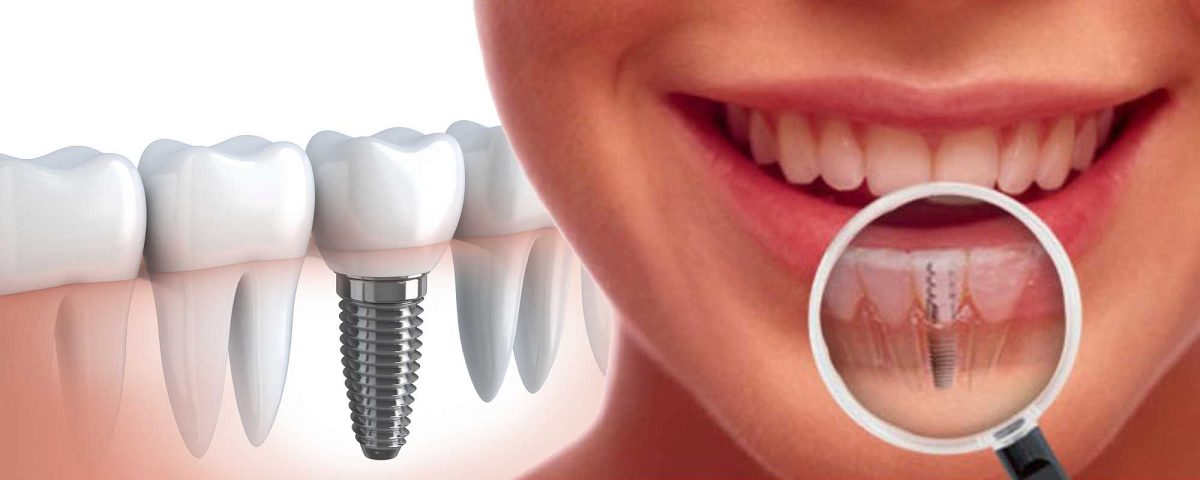 kakvo-opredelya-cenata-na-dentalnite-implanti-1200x480.jpg