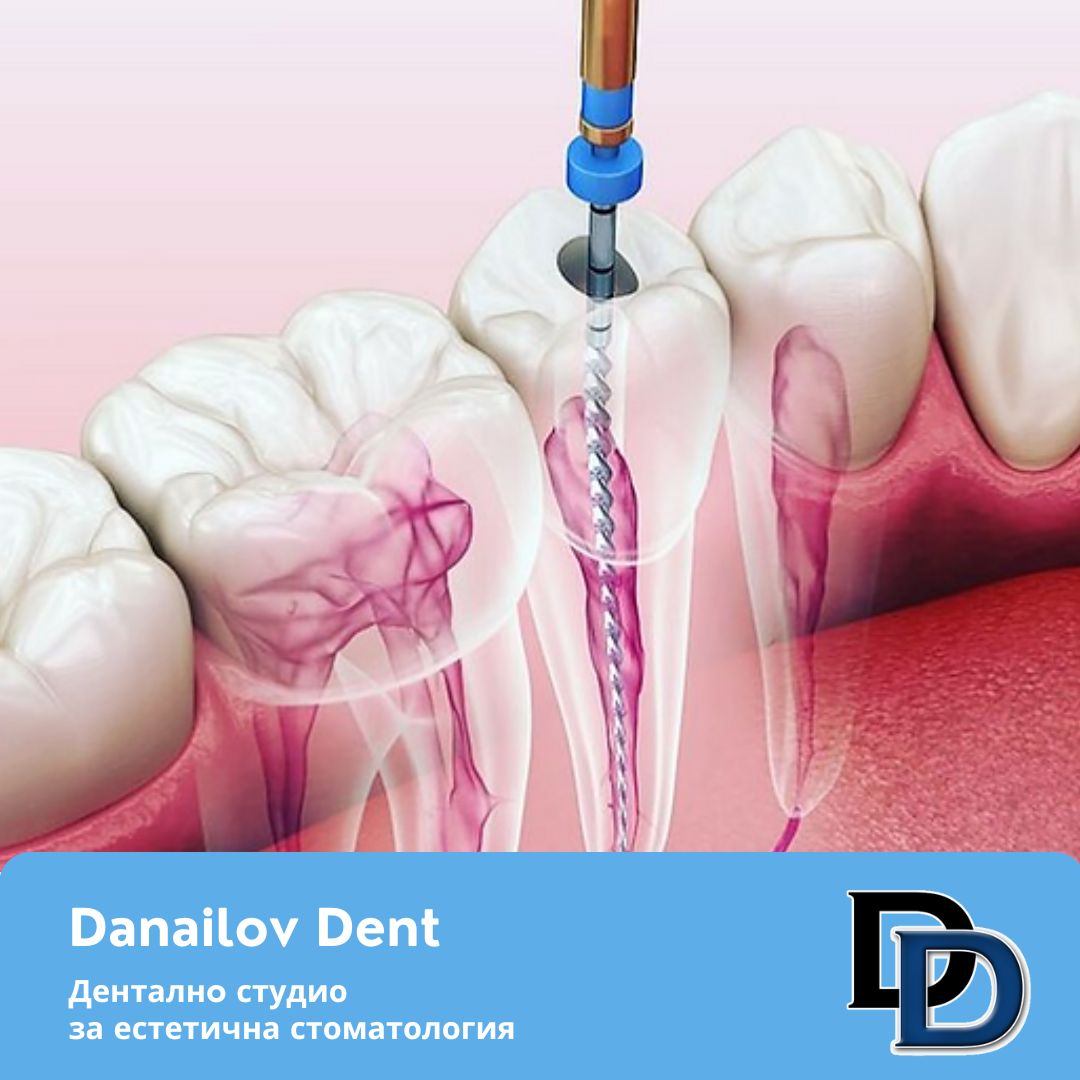 korenovo-lechenie-dentalna-klinika-danailovdent.jpg