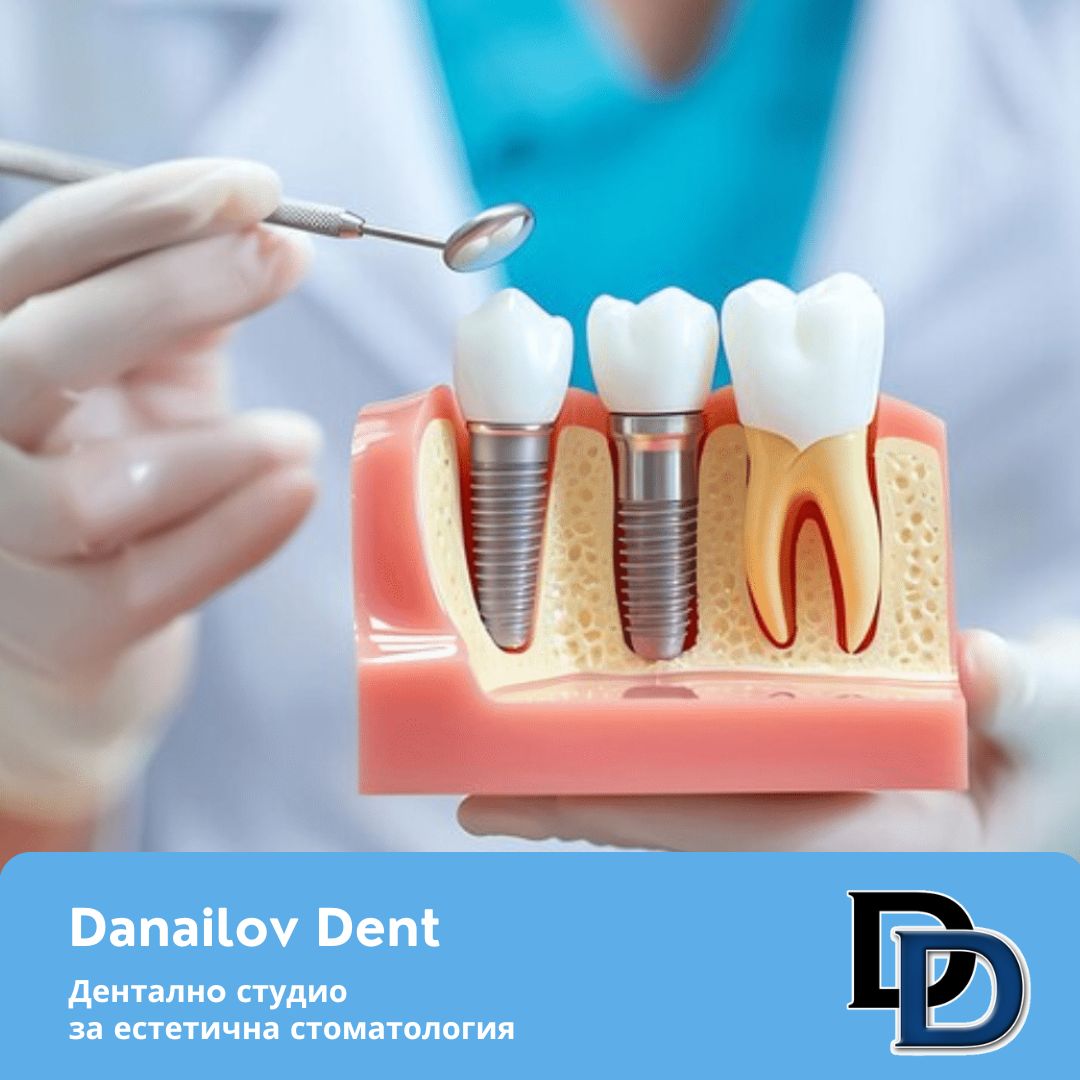 vuzstanovyavane-sled-postavyane-na-implant-danailovdent.jpg