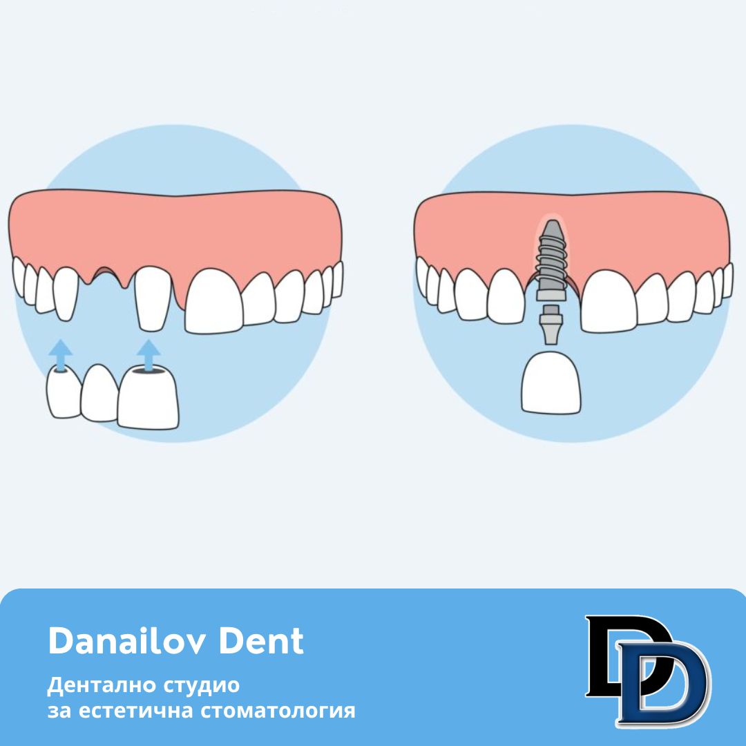 most-ili-implant-danailovdent.jpg